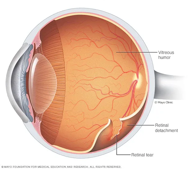 Retinal Detachment (RD) Repair