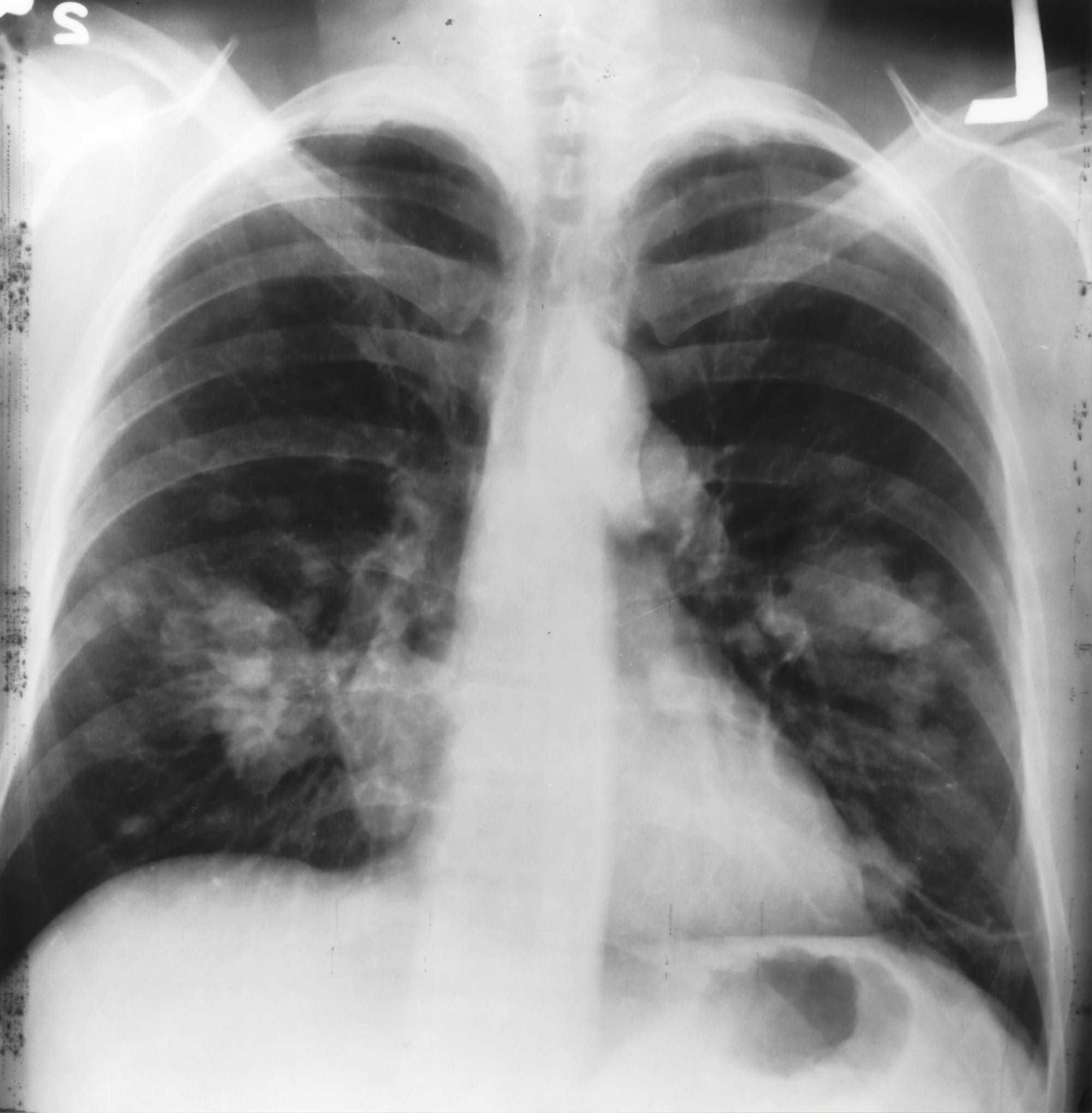 Pulmonary Embolism: Anticoagulate, Thrombolyse, or Wait?