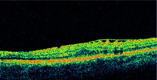 Epiretinal membrane (ERM) peel