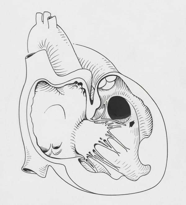 Heart Failure: The 4 Types and How to Treat Each One