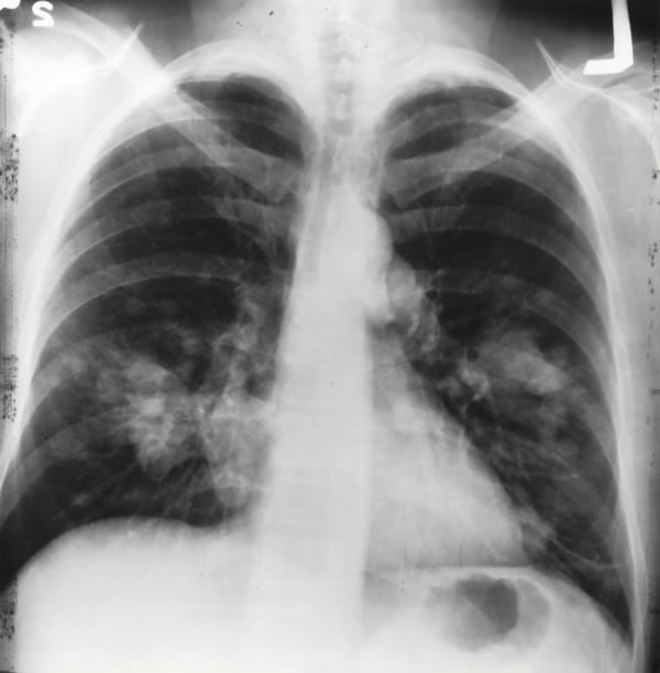 Pulmonary Embolism: Anticoagulate, Thrombolyse, or Wait?